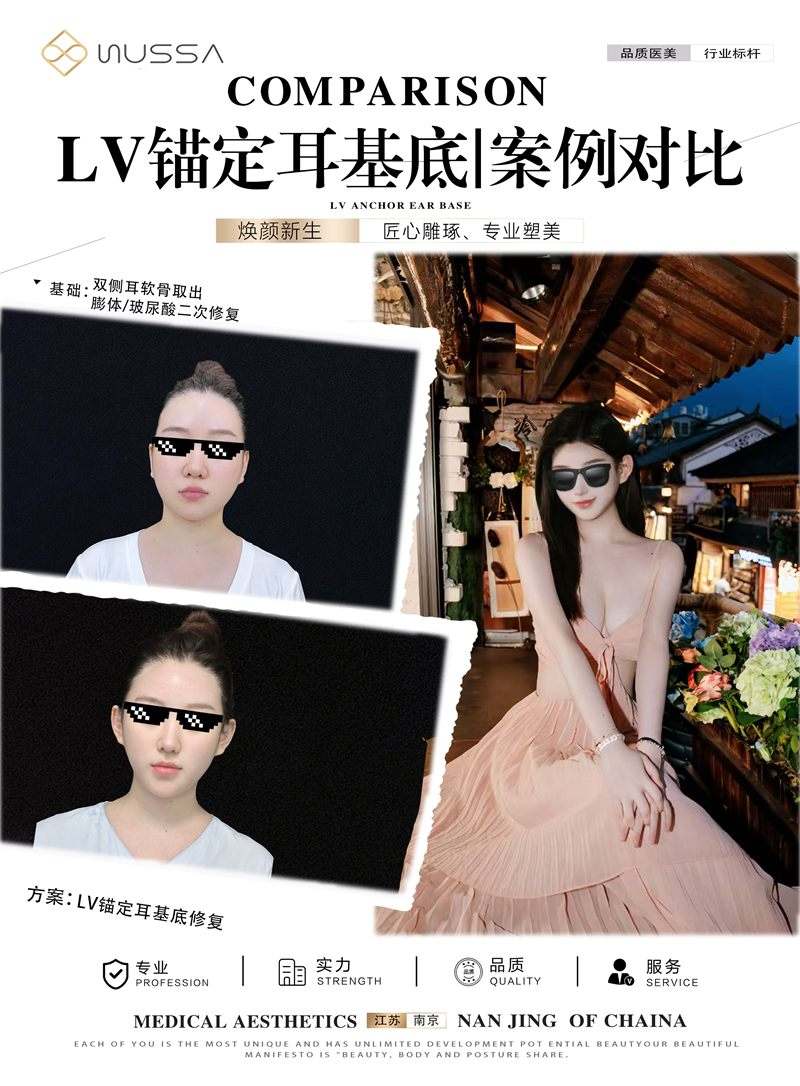 耳基底提升案例十