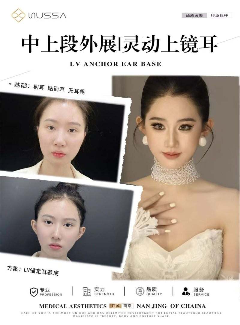 耳基底提升案例四