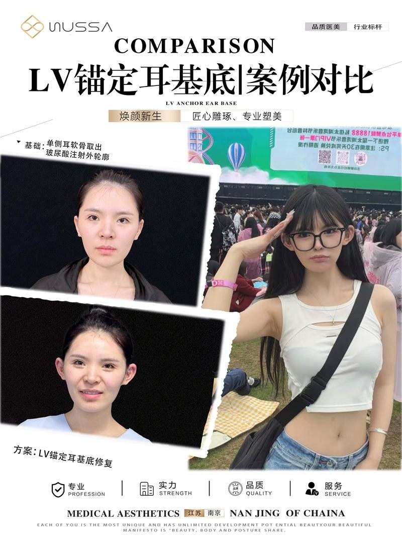 耳基底提升案例九
